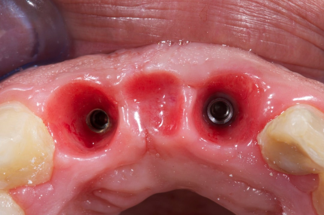 Healing immediate implant sites with cover screws and the peri-implant soft tissue that a provisional is later used to shape