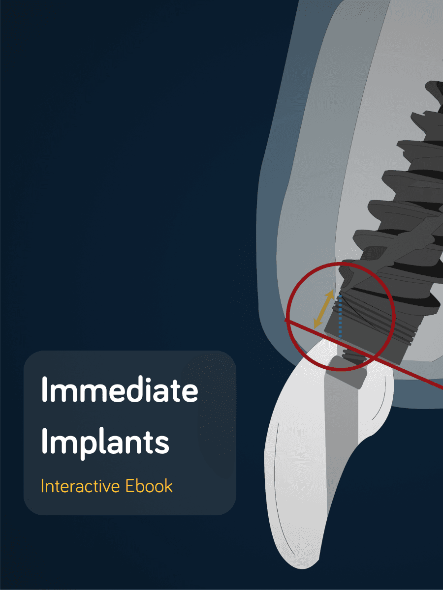 Immediate Implants