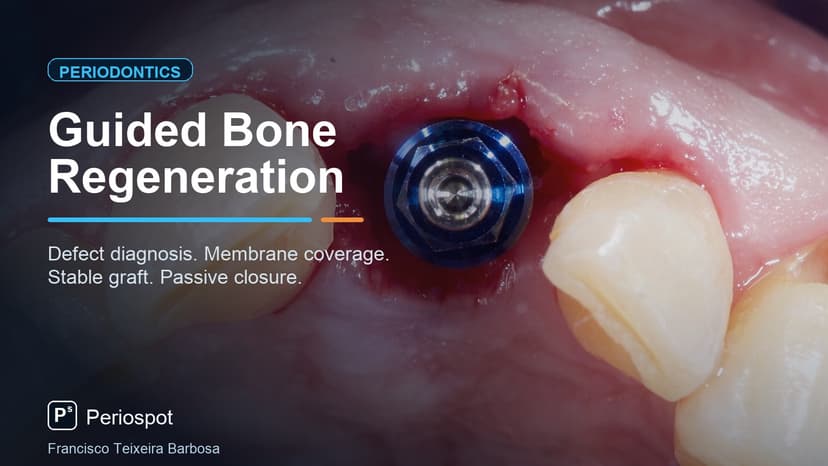 Guided Bone Regeneration: A Clinical Guide to Every Bone Defect