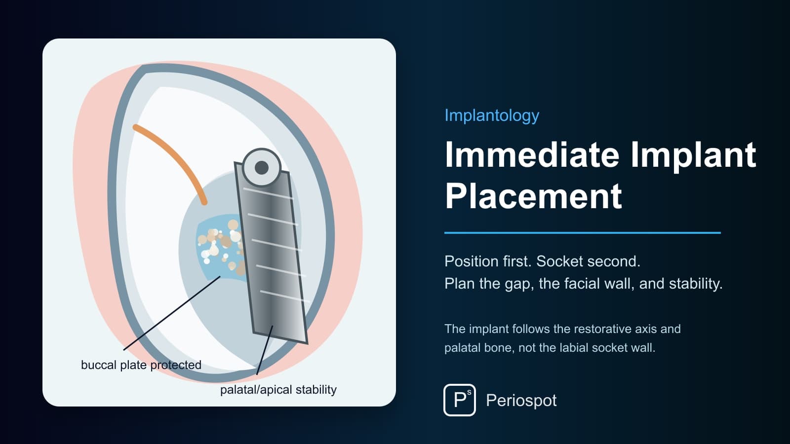 Immediate Implant Placement: A Protocol for Case Selection and Predictable Results