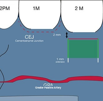 Palatal harvest-window planning diagram with CEJ offset and greater palatine artery position for connective tissue graft