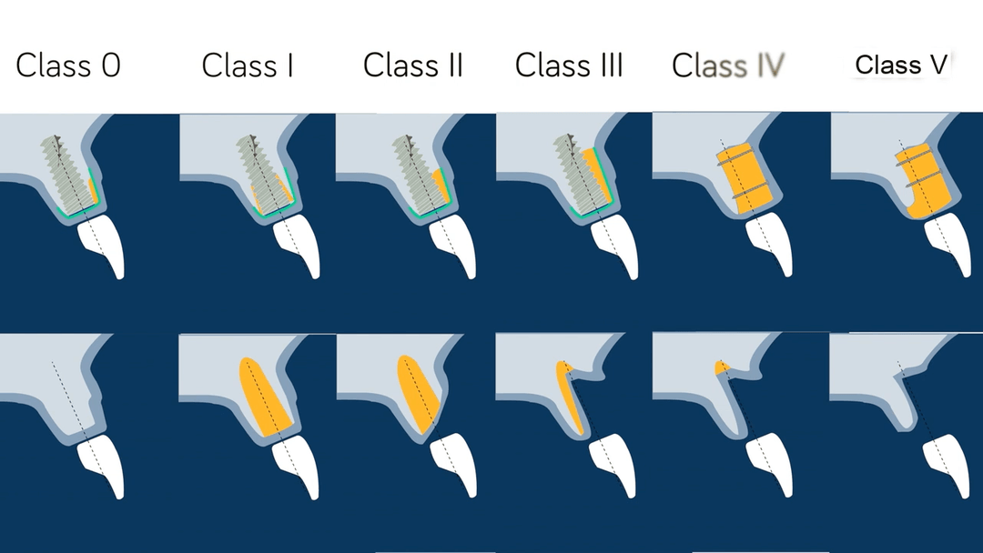 Implant bone defect classification used for GBR planning