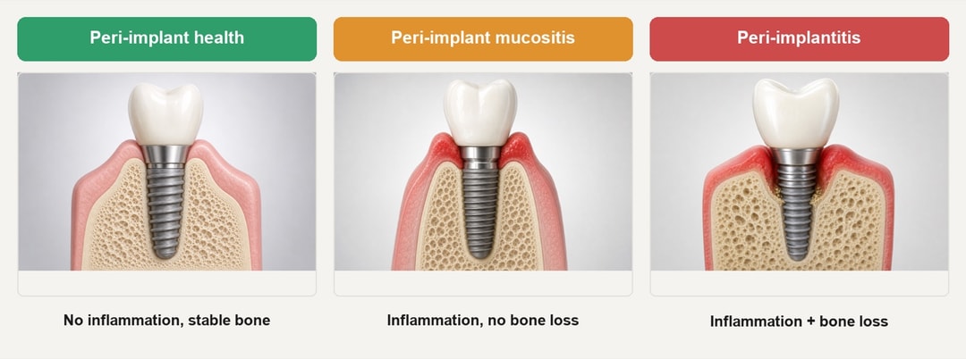 The three peri-implant conditions, health vs mucositis vs peri-implantitis