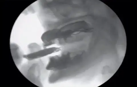 Periospot GIF downsized large