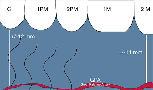 Connective tissue graft techniques. Great palatine artery