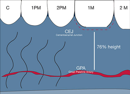 Connective tissue graft techniques. Great palatine artery