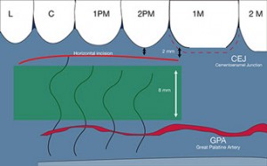 Connective tissue graft techniques. Great palatine artery