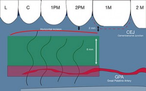 Connective tissue graft techniques. Great palatine artery