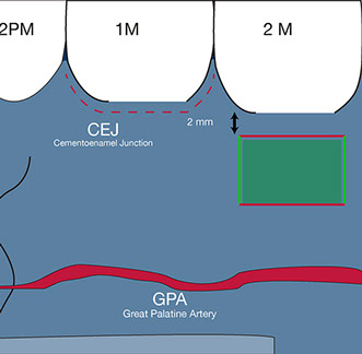 Connective tissue graft techniques posterior palate