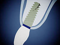 Aurea implante com diente directo y perdida osea