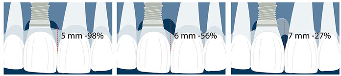 implants in the aesthetic zone and the height of the papilla
