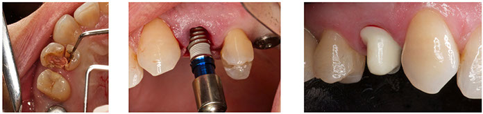 Immediate implants in the aesthetic zone