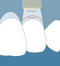 Subcritical and critical contour in implants in the aesthetic zone
