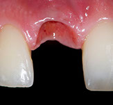 Provisional in implants in the aesthetic zone