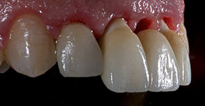 Provisional in implants in the aesthetic zone