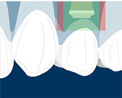 ideal position in the aesthetic zone