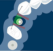 ideal position in the aesthetic zone