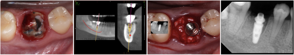 Immediate Implant after extraction of a lower jaw first molar 46 (Neodent® Alvim), and placement of the definitive abutment (32 N.Cm).