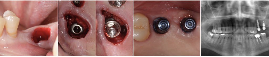 Immediate implant (Alvim, Neodent®) with the definitive Micro-abutment placed the same day of the surgery.