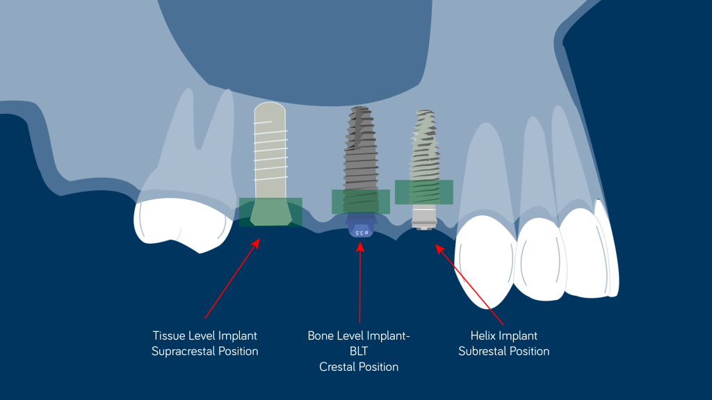 implants positionated Mesa de trabajo