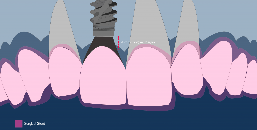Apico coronal position BLX