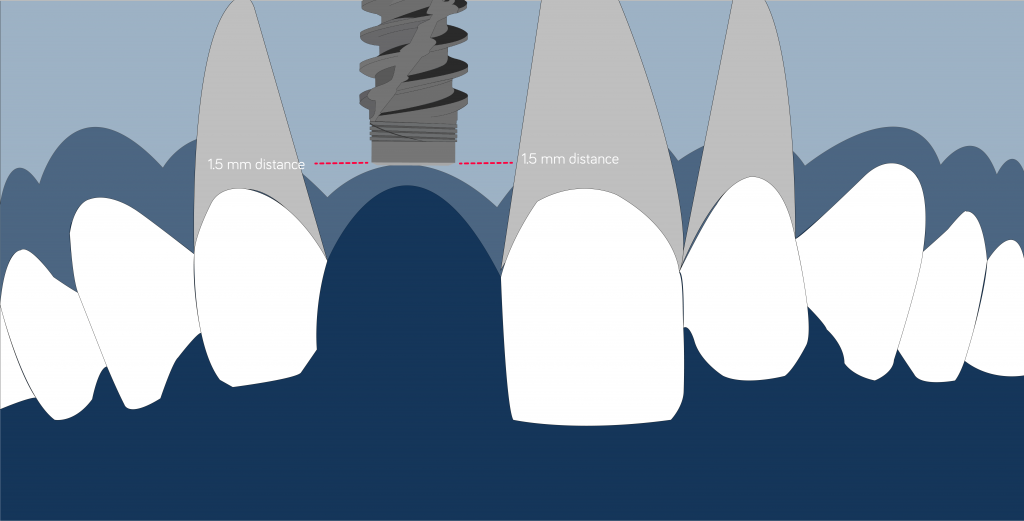 mesiodistal position