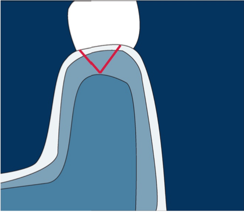Connective tissue graft techniques from the tuberosity