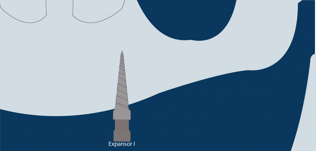expansor