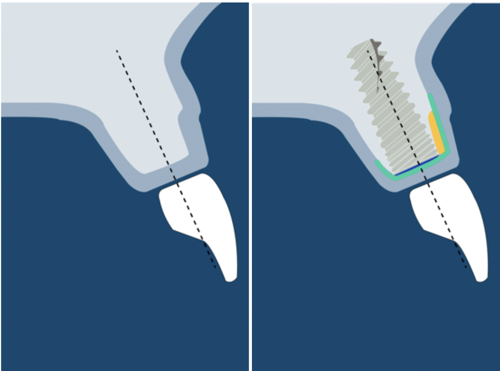 Guided bone regeneration in class 0 defect