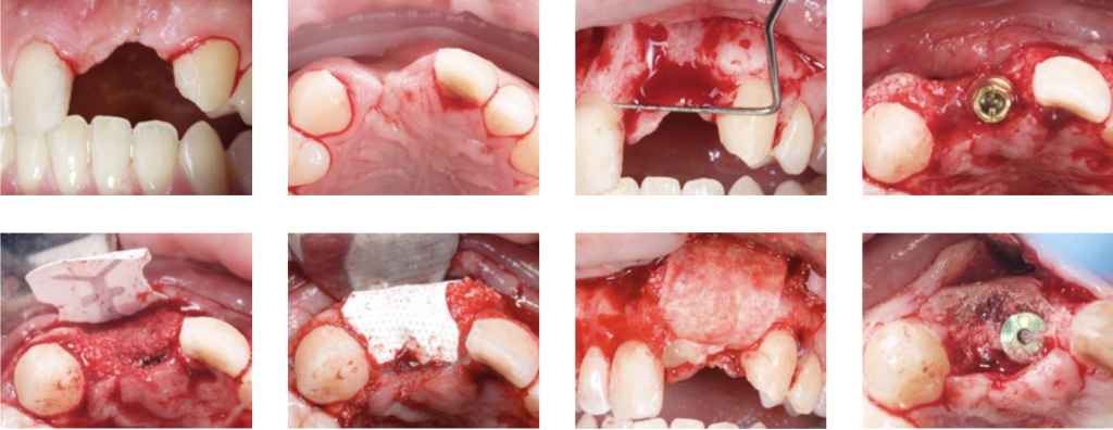 e-ptfe membranes in Suspended External-Internal Suture