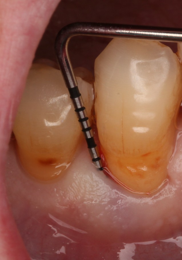 Clinical photograph: a periodontal probe in a residual pocket on the lower right canine, 4 months after non-surgical debridement.