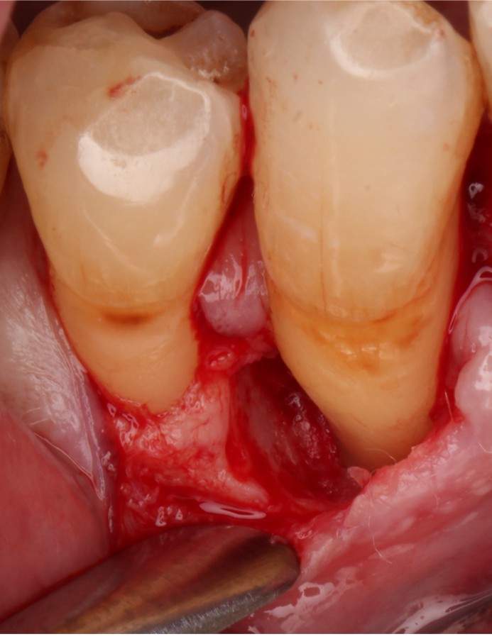 Clinical photograph: a papilla preservation flap raised at the lower right canine, showing the intrabony defect after the granulation tissue was removed.