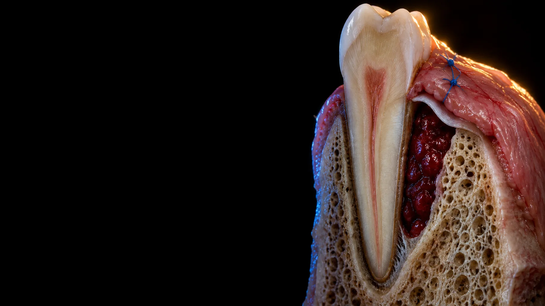 Sagittal section of a premolar during guided tissue regeneration: a blood clot fills an intrabony defect beside the root, under a barrier membrane covered by the sutured gingival flap.