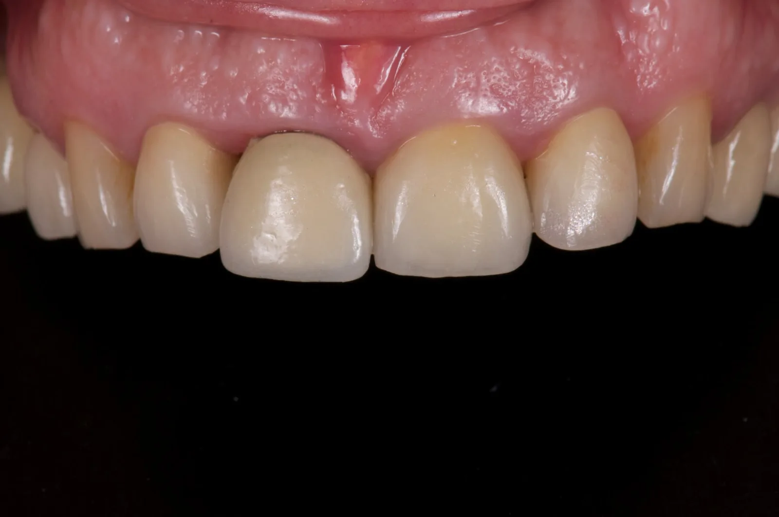 Upper anterior teeth at the first visit, with the crown on 11 in place.