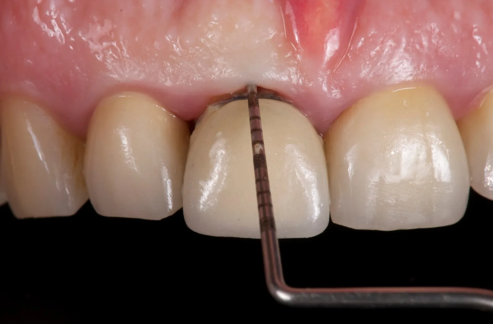 A periodontal probe at the margin of the crown on 11, finding the gap between crown and root.