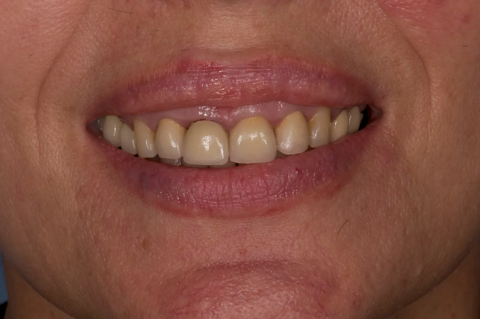 The patient smiling, with a high lip line that shows the gingival margins of the upper incisors.
