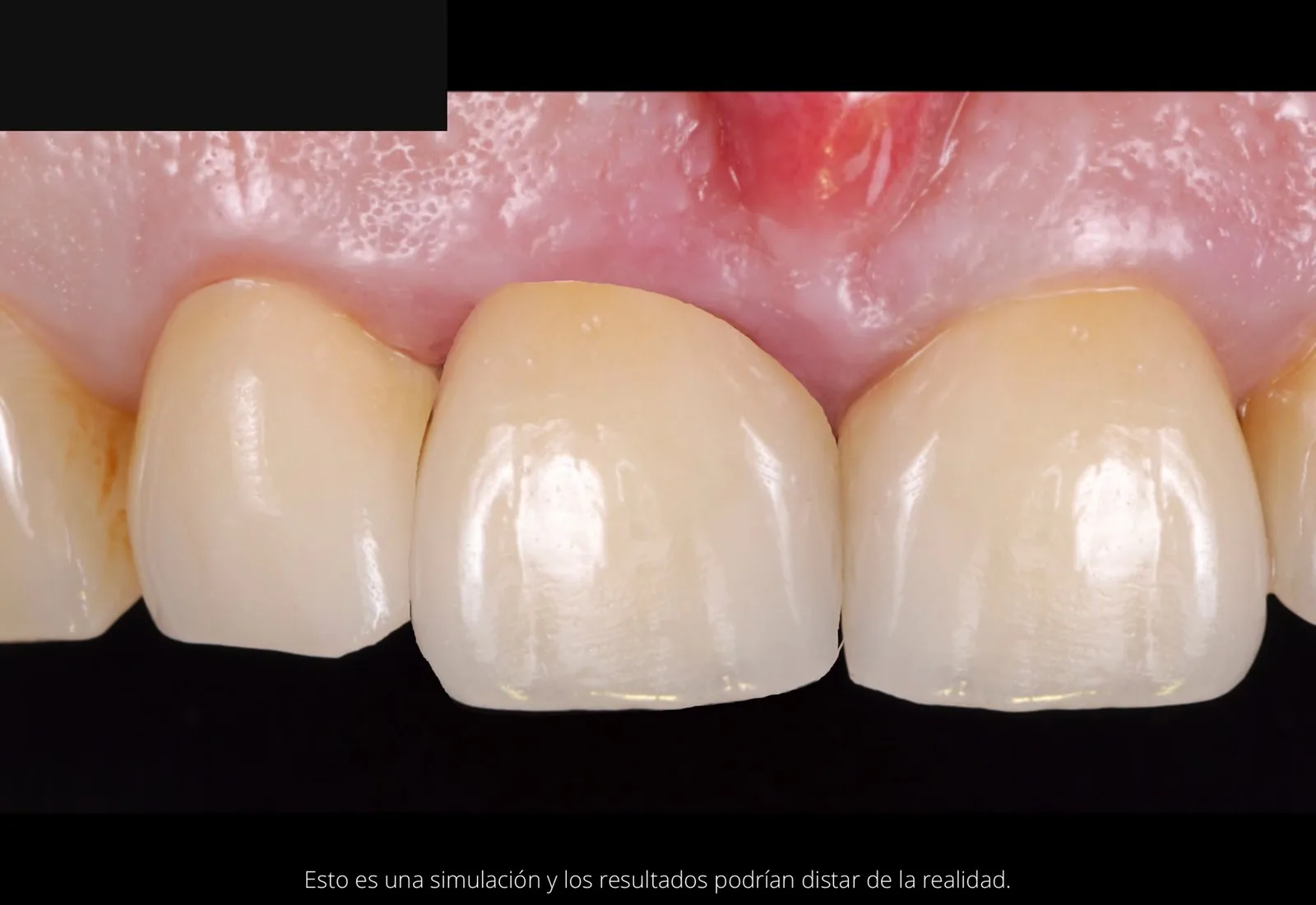 Digital smile simulation of the planned crown on 11.