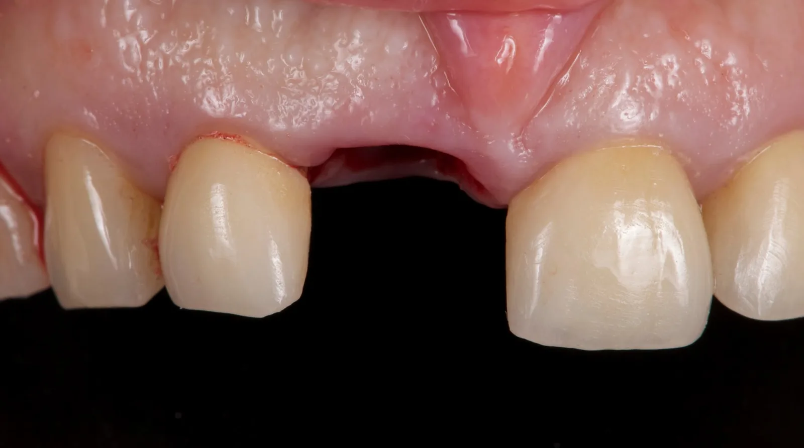 The socket of 11 after removing the palatal fragment, with the buccal shield left in place.