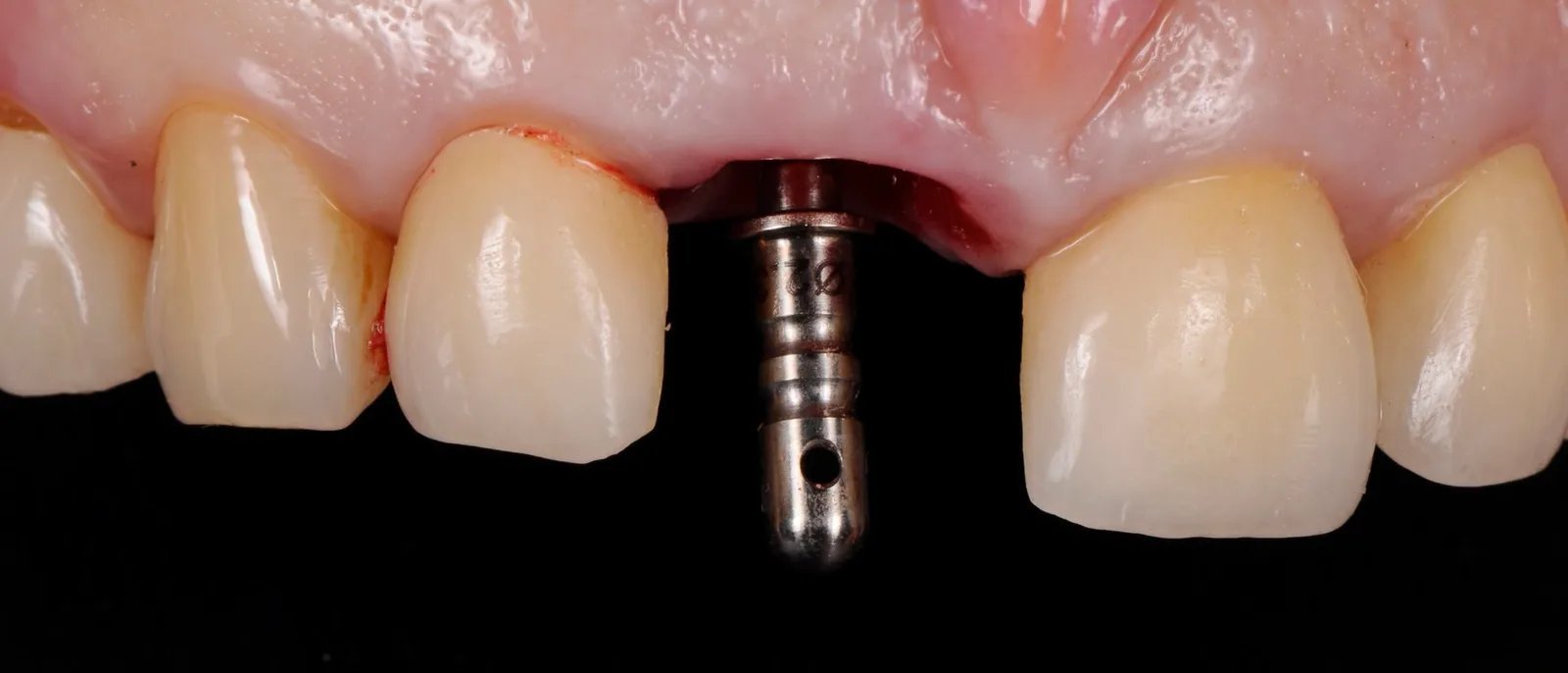 A direction pin in the osteotomy at 11, seen from the front.