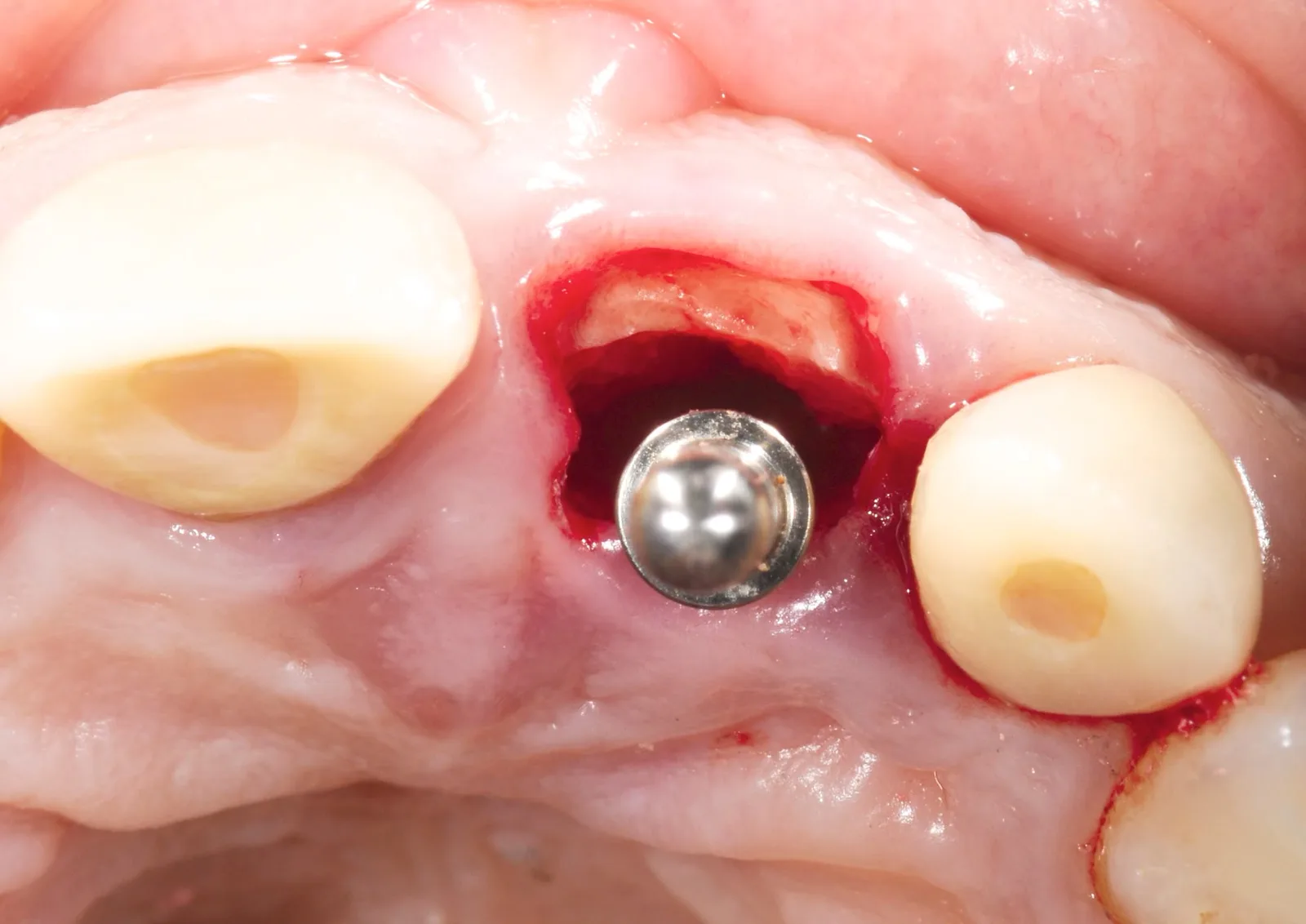 Occlusal view of the socket: the buccal shield and the direction pin in the palatal osteotomy.