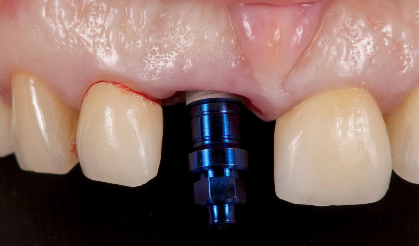 The implant being placed at 11 with its mount, seen from the front.