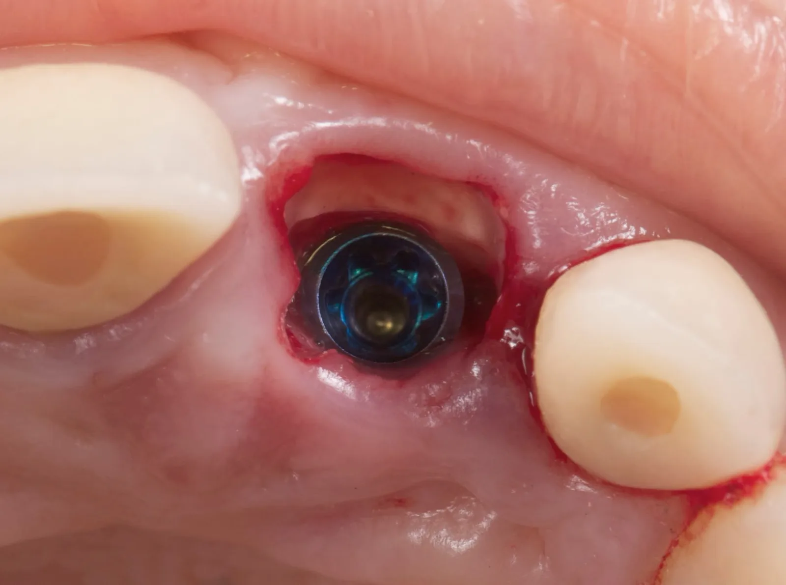 Occlusal view: the implant palatal to the buccal shield, in slight contact.