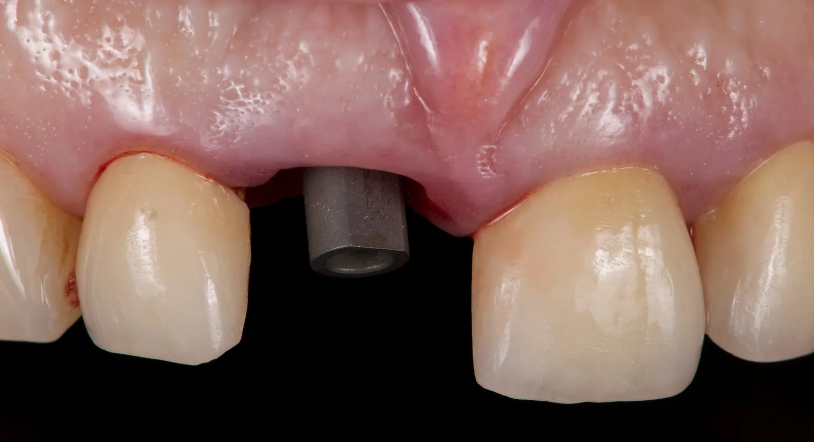 Scan body on the implant at 11 for the digital impression.
