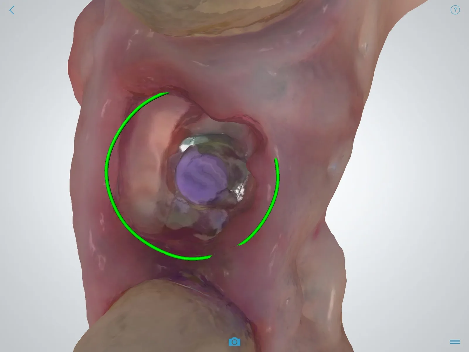 The intraoral scan of the site, with the shield visible.