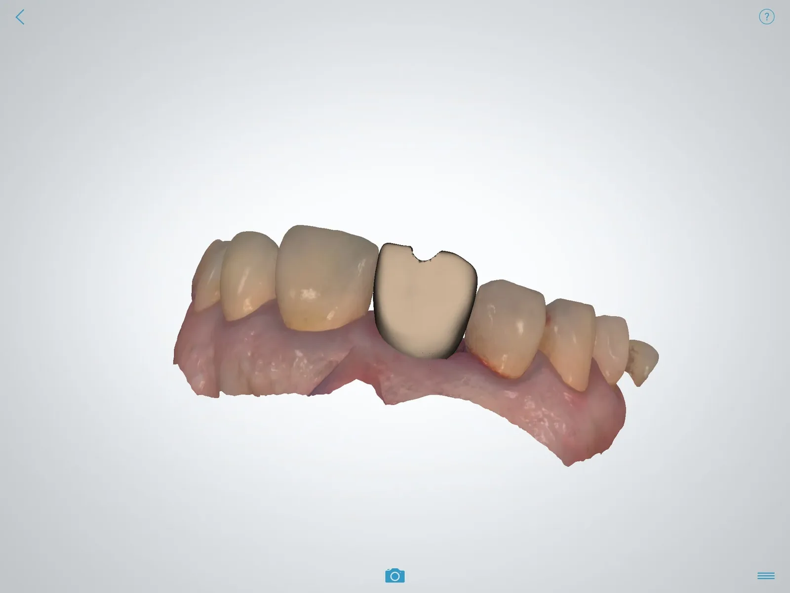 Digital design of the PMMA provisional crown on the model.