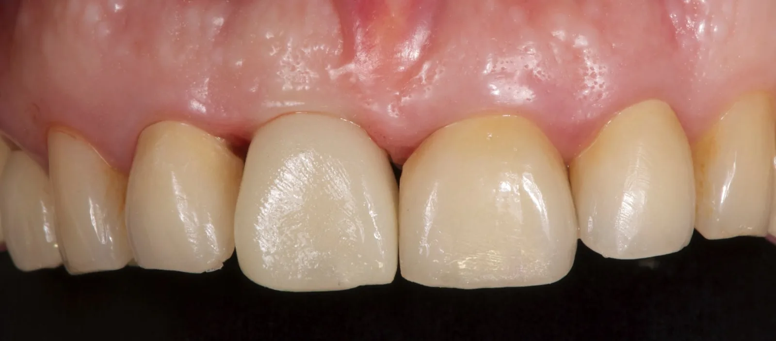 The milled PMMA provisional crown in place on 11.