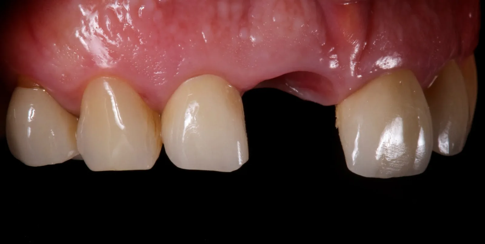 The peri-implant soft tissue at 11 after removing the provisional at four months.
