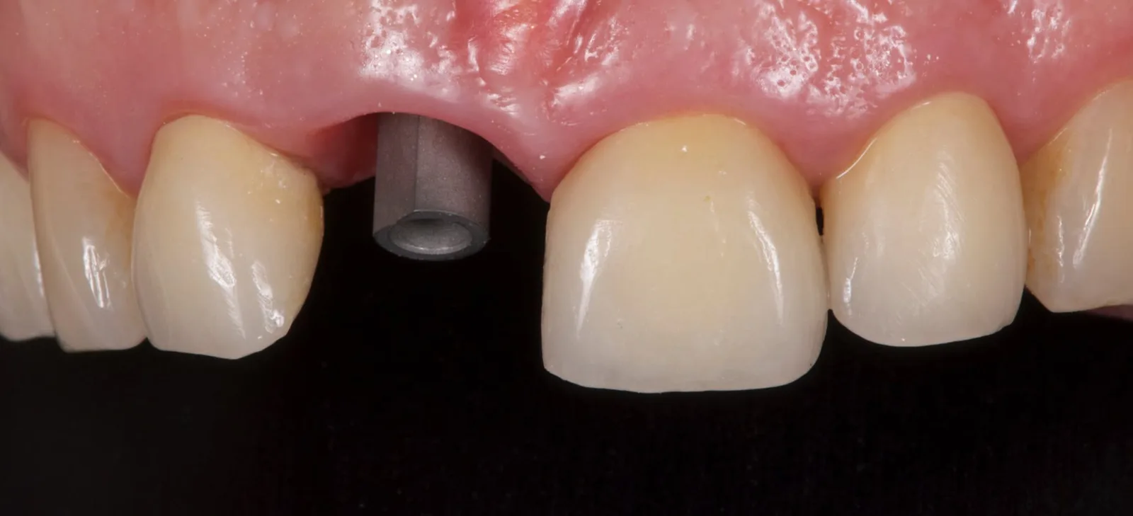 Impression coping on the implant at 11 for the final impression.