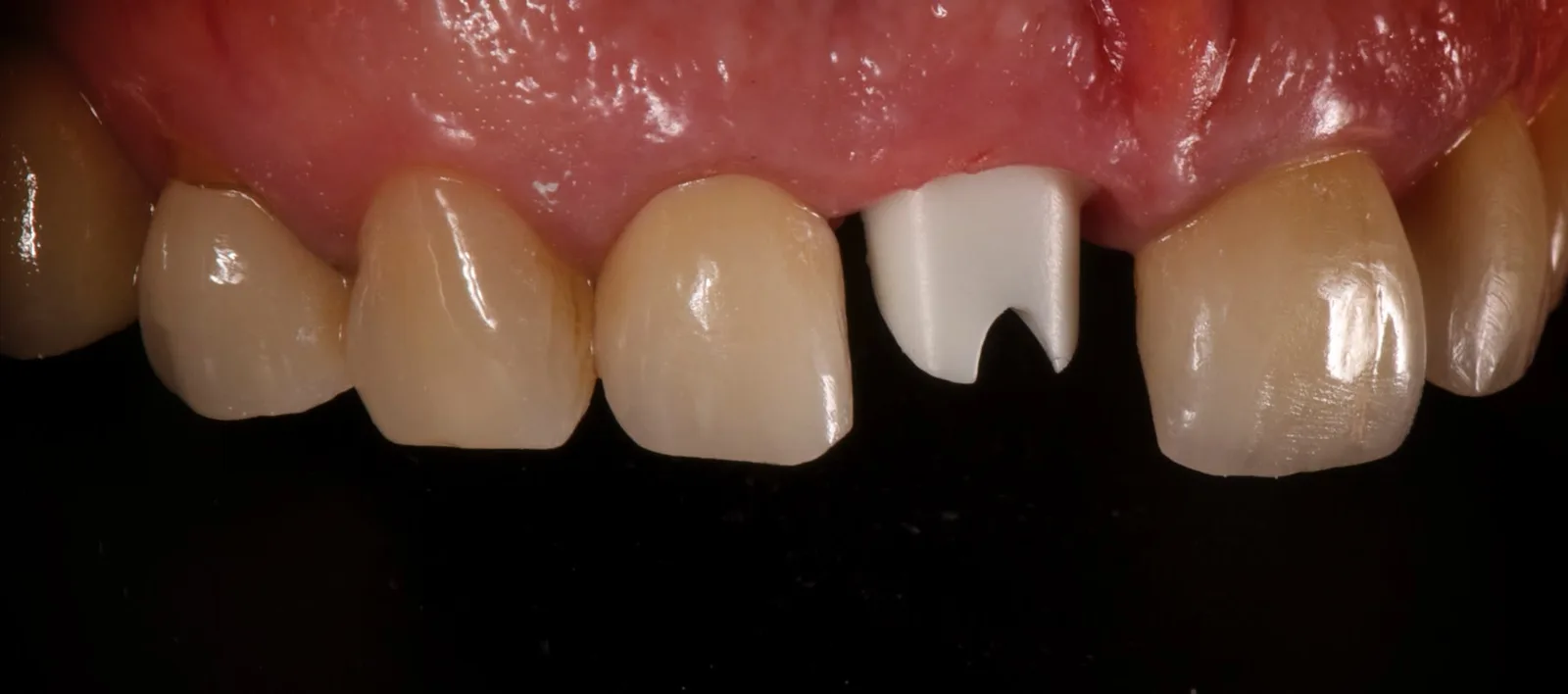 Custom zirconia abutment try-in on 11, margin slightly below the gingiva.