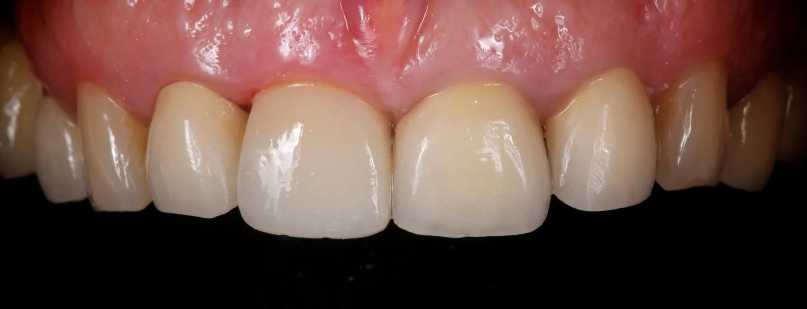 The definitive crown on 11 next to the natural teeth.